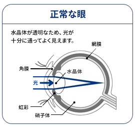 正常な眼