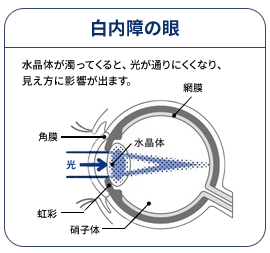 白内障の眼