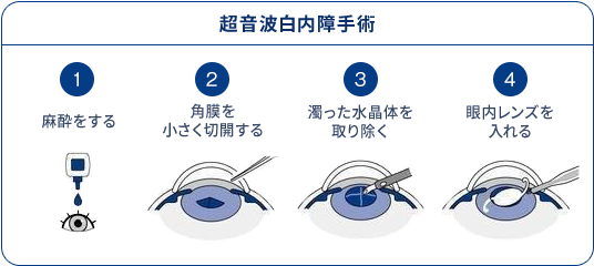 超音波白内障手術